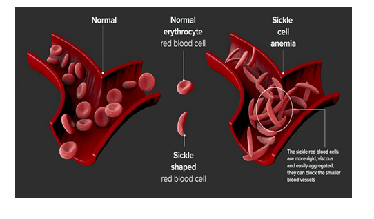 FDA Approves First Gene Therapies to Treat Patients with Sickle Cell ...